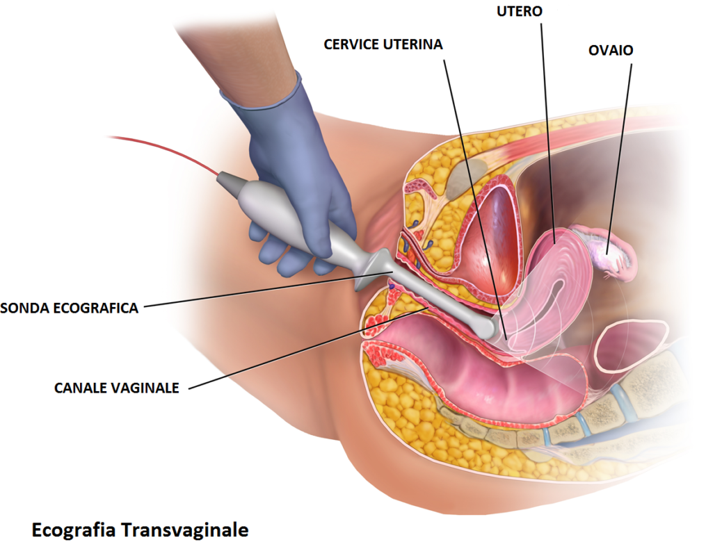 Ecografia-transvaginală Dr. Stela COJOCARU Medic specialist obstetrica-ginecologie