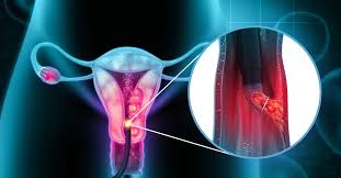 Biopsie Endometrială