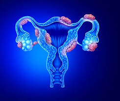 endometrioza schema