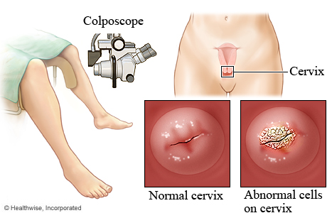 Videocolposcopypia Avantajele videocolposcopiei • Diagnostic rapid și precis; • Permite detectarea precoce a leziunilor precanceroase; • Procedură sigură, fără durere și fără riscuri; • Imaginile se pot stoca și compara în timp, pentru urmărirea evoluției.